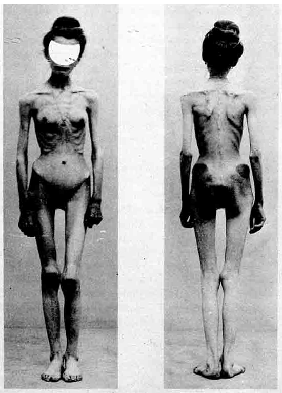 Anorexia_case_1900